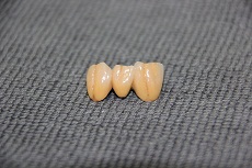 răng sứ
