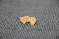răng sứ