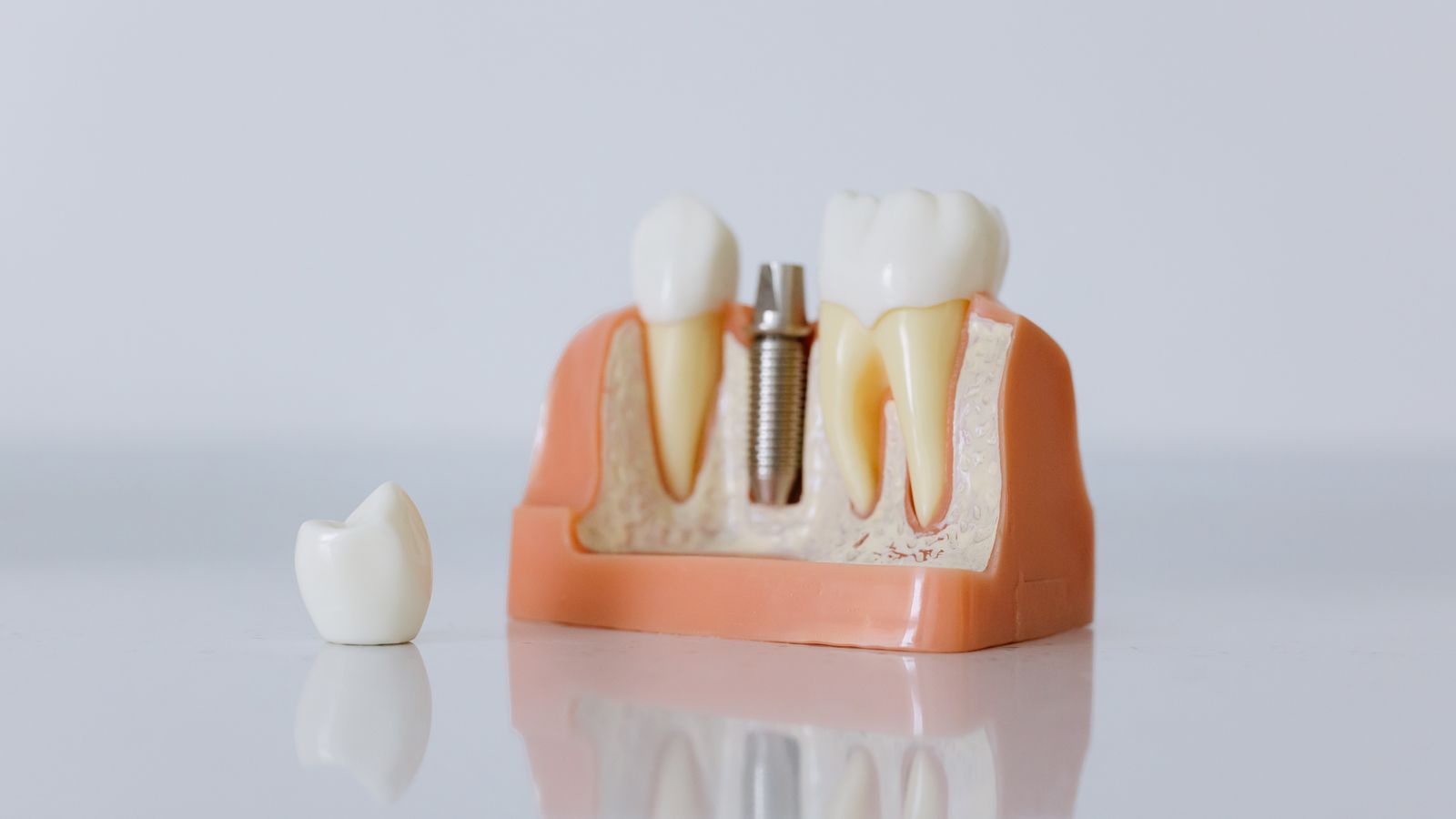 Răng sứ là gì? Điều cơ bản cần biết trước khi làm